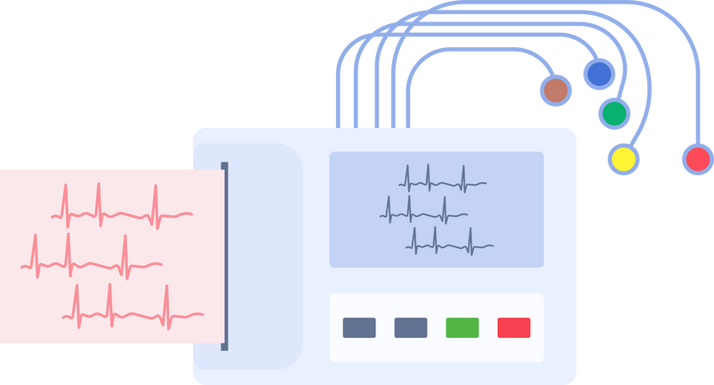 EKG ECG arrhythmias Irregular rhythms palpitation electrical coronary artery attack chest pain disease signal test screening monitor holter stress Implantable loop recorder